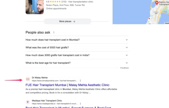 Hair Transplant Mumbai