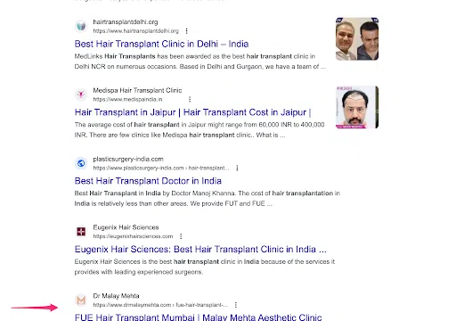 Malay Mehta 9th for hair transplant india